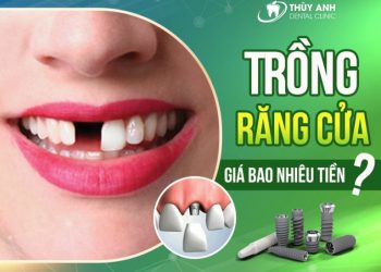 Trồng răng cửa bao nhiêu tiền? Tìm địa chỉ trồng răng uy tín 