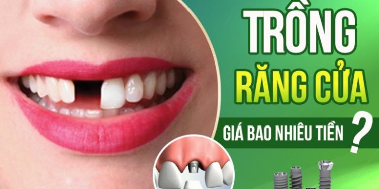 Trồng răng cửa bao nhiêu tiền? Tìm địa chỉ trồng răng uy tín 